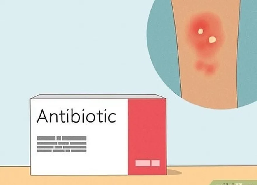 3-qadam infektsion holatida buyurilgan antibiotikni qabul qiling.