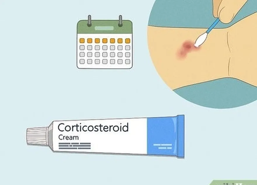 1-qadam bir haftagacha retseptsiz kortikosteroid kremidan foydalaning.