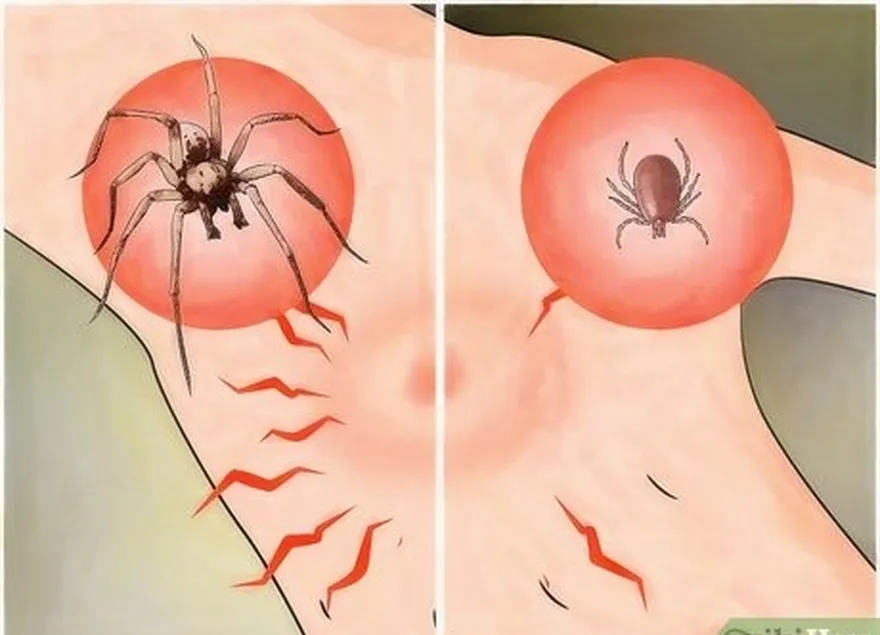 3-qadam't confuse tick bites as spider bites.